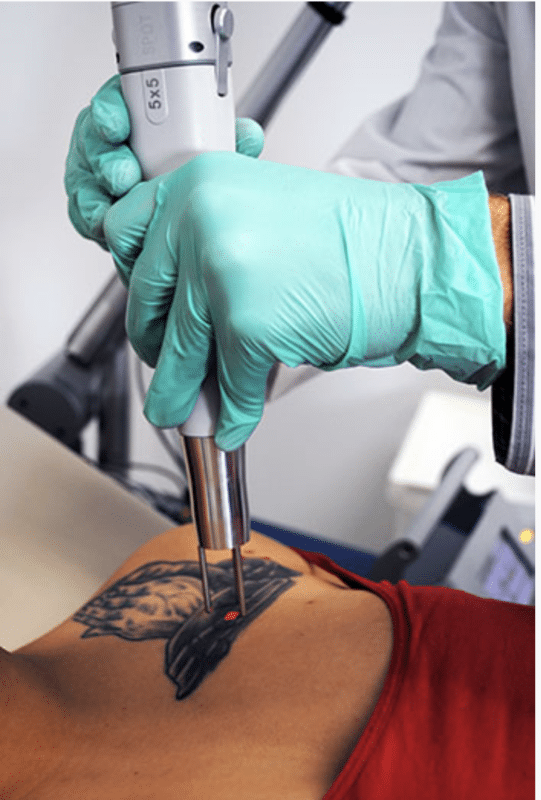 What To Consider Before A Tattoo Removal